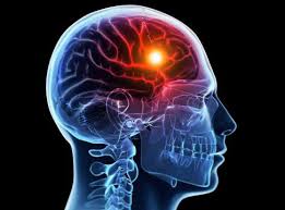 6 Cara Mudah Terhindar dari Serangan Stroke
