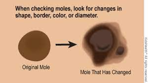 Symptoms of basal cell carcinoma appear on areas exposed to the sun, such as the head, face, neck, arms, and hands. Melanoma For Parents Nemours Kidshealth