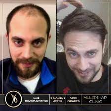Million Hair Center Sac Ekim Merkezi