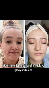 I love this transformation so much! Watch her skin change completely! Just  TRUST me! You don’t need medications to clear your skin. I can help you,  just message me to get started. , #clear skin ...