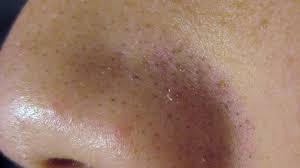 Sebaceous Filaments Treatments And Causes