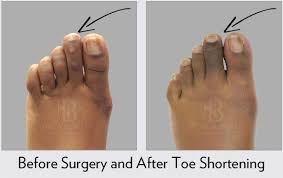 Toe Shortening Before After Hammer Toe Surgery Hammer Toe Surgery