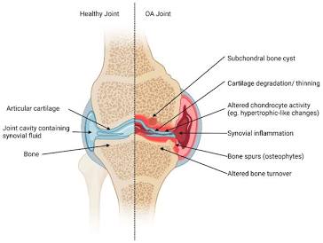 Healthy joint vs. degraded joint suffering from cartilage loss and inflammation, AI generated