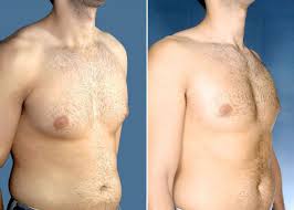 Pin On Gynecomastia Surgery