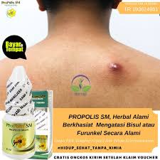 Related for resep mujarab tradisional bisul di kepala (keongen). Obat Bisul Di Kepala Untuk Anak Bayi Dan Orang Dewasa Bisulan Pada Kelopak Mata Atas Belakang Pecah Shopee Indonesia