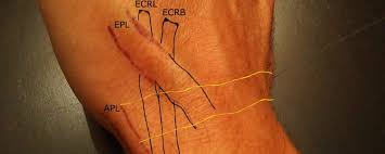 Image result for Intersection Syndrome