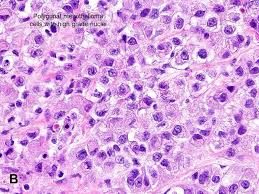 Sarcomatoid mesothelioma is easy to misdiagnose as a number of fibrous conditions, both cancerous and. Malignant Mesothelioma Mm American Urological Association