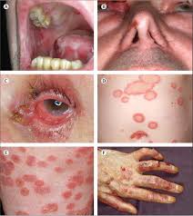Image result for Pemphigoid