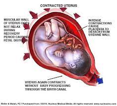 Cytotec Misuse Can Harm Babies Birth Injury Attorneys