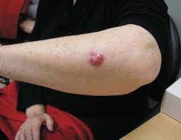 Your doctor will check for lumps, lesions, or irregularly merkel cell carcinoma is considered an aggressive type of cancer. Merkel Cell Carcinoma Adnexal Carcinoma And Basal Cell Carcinoma Springerlink