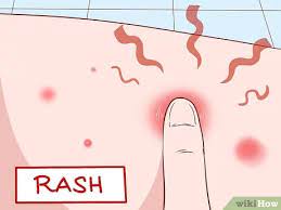 Maybe you would like to learn more about one of these? Symptome Einer Mrsa Infektion Erkennen 13 Schritte Mit Bildern Wikihow