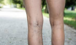 Varizes: conhe&ccedil;a as principais causas e efeitos - Guiame