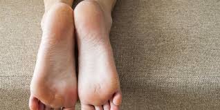 9 Cara Menghilangkan Kapalan Dengan Bahan Bahan Alami Merdeka Com