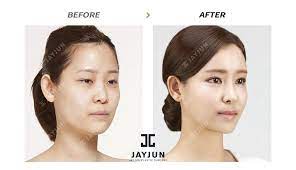 The Best Plastic Surgery In Korea Korean Star Plastic Surgery Korean Women Plastic Surgery Top Plastic Surgery In Korea Top Korean Plastic Surgery Top Plastic