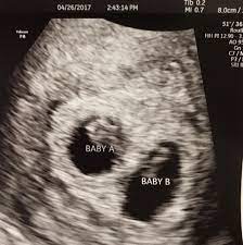 What are the symptoms of twins in first trimester? Went For My 7 Week Ultrasound Yesterday Found Out That We Re Expecting Twins To Say That We Were Shocked Is An Understatement Last Year Our 18 Day Old Daughter Went To