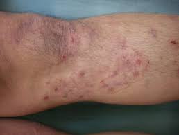 Majocchis Granulom Dermatly Com Die Website Ihrer Haut