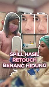 Retouch Hidung Kevin Petterson: Lihat Hasilnya!