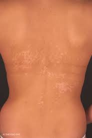 The name of this condition comes from the fine scaly appearance that is initially evident in suffering individuals (pityriasis) as. Pityriasis Versicolor Ubersicht Altmeyers Enzyklopadie Fachbereich Dermatologie