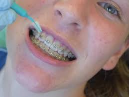You may not have any symptoms at first. What Happens If You Have Braces And Don T Brush Your Teeth