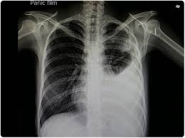 A pneumonia afeta com maior freqüência e gravidade os idosos 6. Que E Pneumonia Viral