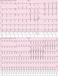 Image result for Left Axis Deviation