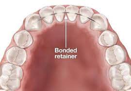 A permanent retainer cost can be up to $500 for one and $1,000 if you get a retainer on your both lower and upper teeth. What Are Permanent Retainers And How Do They Work Orthodontic Specialists Of White Plains