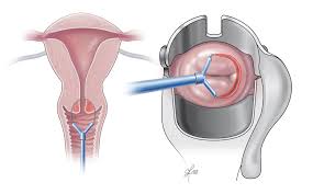The most common symptom of endometrial cancer is abnormal vaginal bleeding. Endometrial Ovarian And Cervical Cancer