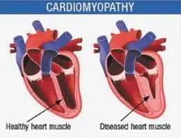 Image result for Cardiomyopathy
