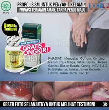 Singa banyak digunakan sebagai lambang negara, seperti di negara singapura misalnya. Jual Obat Pembasmi Bakteri Penyebab Sifilis Sipilis Raja Singa Infeksi Luka Di Kulit Pada Mulut Alat Kelamin Dubur Penyakit Menahun Propolis Sm Di Lapak Toko Ria Herbal Bukalapak