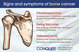 Pain is the most common symptom of bone cancer. Loading Sarcoma Cancer In Leg Symptoms