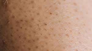 Why do ingrown hairs become such an issue? Ingrown Hair Problem Try These Products To Eliminate Them Peoplehype