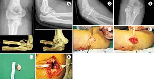 Image result for Coronoid Process Fracture