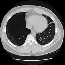 Image result for Incidental Imaging Finding