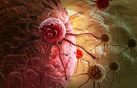 Ebrahimian integrative dentistry wouldn't be surprised if you had never heard of oral cancer, oral cancer awareness month, or if you'd never had an oral cancer screening. Signs That You May Have Oral Cancer Dentist In Mount Airy Surry County Nc