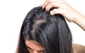 If you have an oily scalp and dandruff, witch hazel can help curb these issues and unclog your pores. Oily Greasy Scalp Try These Holistic Ayurvedic Treatments Vedix