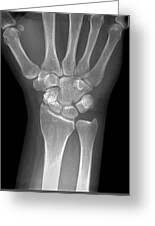Image result for Wrist XRay