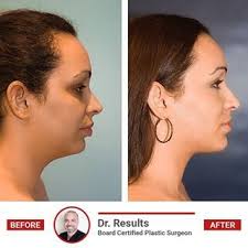 Pin By Beyond Beauty Plastic Surgery On Https Www Beyondbeautyplasticsurgery Com Beyond Beauty Plastic Surgery Cosmetic Procedures