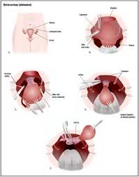 Cervical cancer is cancer that begins in the uterine cervix, the lower end of the uterus that women who have had a total hysterectomy for a benign condition no longer have a cervix. Hysterectomy Procedure Recovery Blood Tube Removal Pain Complications Time