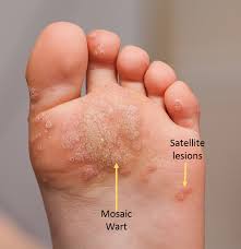 Certain chemotherapy drugs are known to cause peripheral nerve damage, so ask your cancer doctor about the side effects of treatment. The Importance Of Treating A Wart In A Timely Fashion Prairie Path Foot Ankle Clinic