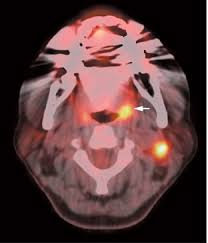 Image result for Primary Tumor Localization