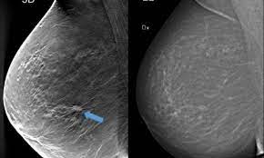Overall, the sensitivity of mammography is about 87 percent  31 . 3d Mammography Detected 34 More Breast Cancers In Screening Healthcare In Europe Com