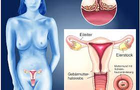 Hpv can cause cervical and other cancers including cancer of the vulva, vagina, penis, or anus. Gebarmutterhalskrebs Symptome Heilungschancen Minimed At