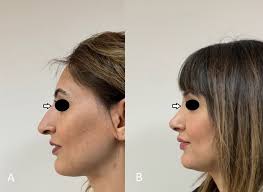 The preoperative (A) and postoperative (B) anterior side image of the...
