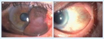 Image result for conjunctival melanoma