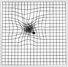 Posted on october 27, 2017 by ardit. Epiretinale Gliose Wenn Membranen An Der Netzhaut Ziehen