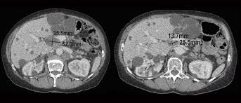 The ovaries are a pair of small organs located low in the tummy that are connected to the womb and store. Taking Molecular Snapshots Of Ovarian Cancer Healthcare In Europe Com