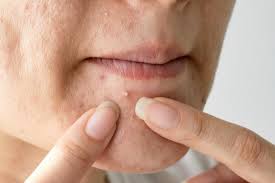 Blind pimples or comedones (pimples with no head) are known to be the most painful because they lie deep closest to nerves on forehead and face area. Pimples On The Chin What It Means And How To Get Rid Of Them