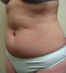 It is also important to note that the procedure however does not guarantee that people who undergo liposuction will not gain any weight. Liposuction Cost In New York New York Liposuction Center