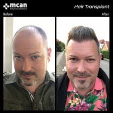 A smaller hair transplant requires less time, less personnel and has a reduced cost of around $6,000 to $8,000. Best Hair Transplant In Turkey Get Your Hair Back Now Mcan Health