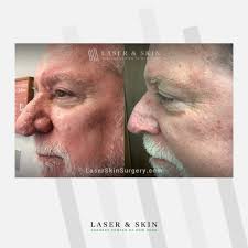 Rhinophyma is a condition of the skin that affects the nose. It causes it  to become enlarged, red, and bumpy. Although the cause of this skin  condition is unknown, it is considered